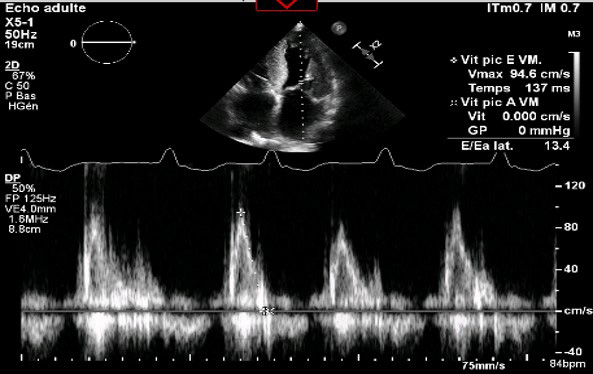 Mesure du flux transmitral au doppler pulsé