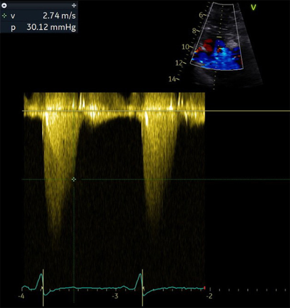 Gradient maximal intra VG en doppler couleur