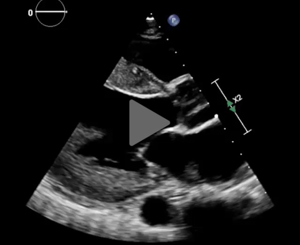 Syndrome_oedémateux_video1_img