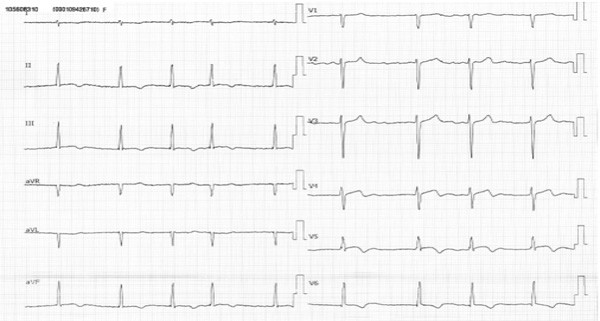 Electrocardiogramme