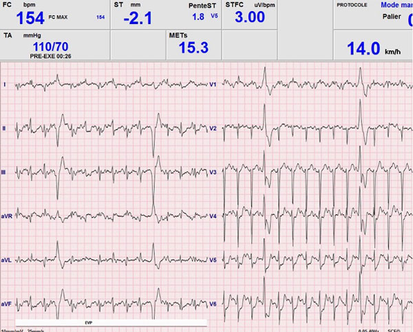 Image 2 du cas clinique "Une amylose AL précoce"