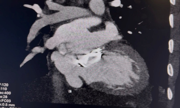 Complication-rare-d-un-remplacement-valvulaire-mitrale-figure1.jpg