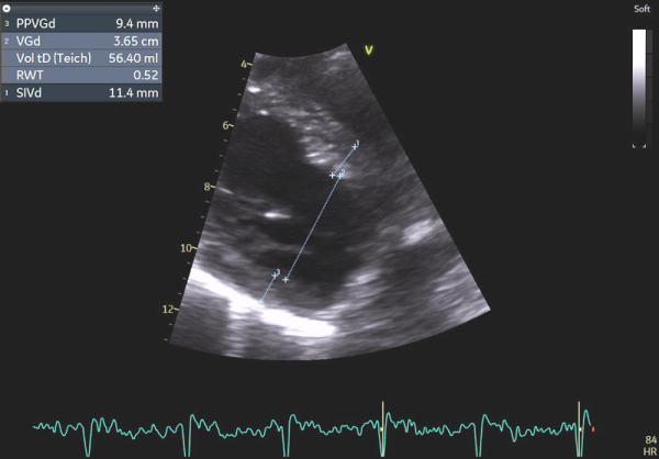 Image 1 : échocardiographie 2D en incidence parasternale grand-axe : mesures des parois du ventricule gauche (VG)