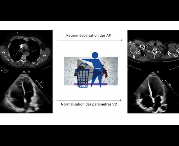 un-infarctus-mais-pas-du-myocarde-vidéo13-img