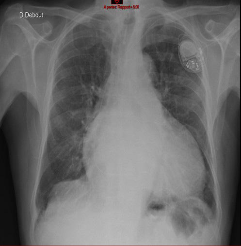 Décision d’implantation de stimulateur cardiaque