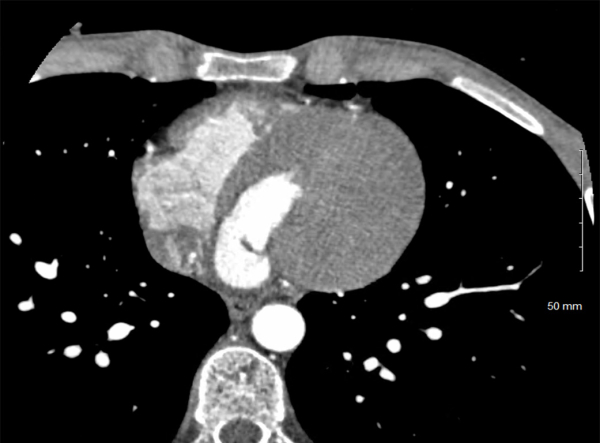 Le syndrome du Caméléon - Scanner Cardiaque 1