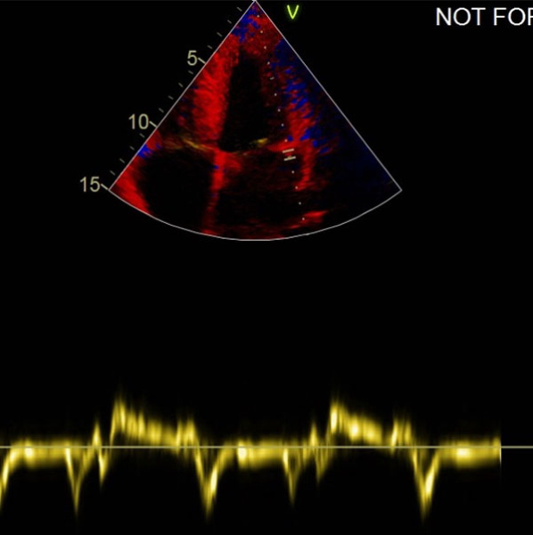 Image 7 du cas clinique "Une amylose AL précoce"