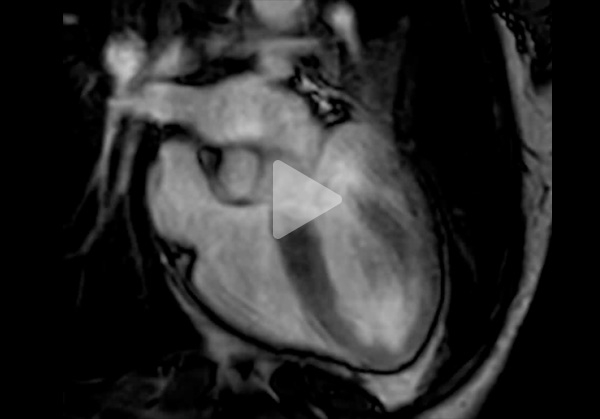 Vidéo 7 du cas clinique "Une amylose pas comme les autres »