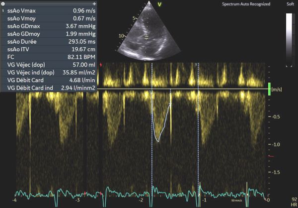 Image 6 : échocardiographie Doppler pulsé sous-aortique avec estimation du débit cardiaque