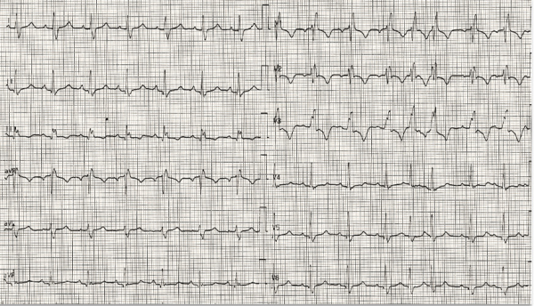 ECG