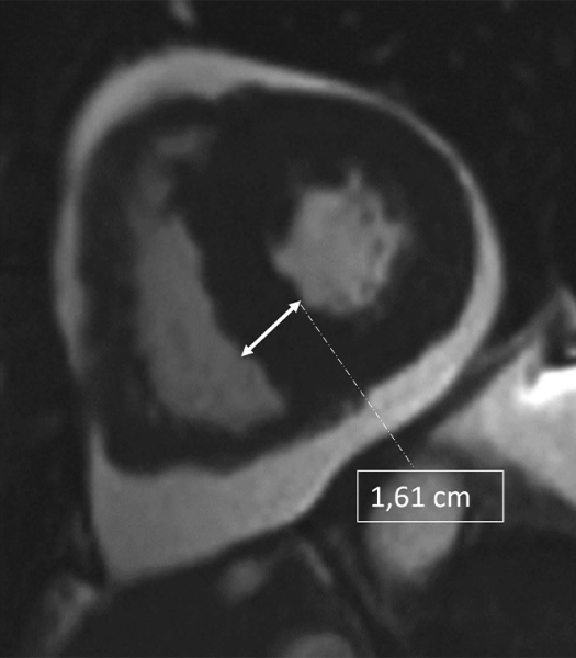 Hypertrophie ventriculaire gauche 