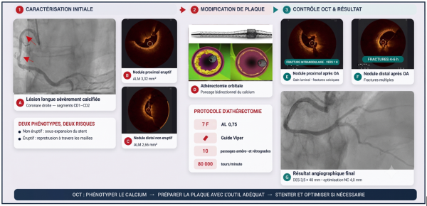 Les calcifications coronaires.png