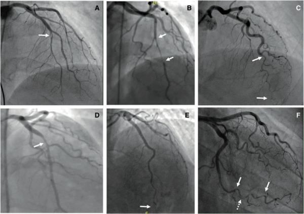 Classification agiographique des dissections coronaires spontanées. Type 1 (A), Type 2A (B), Type 2B (C), Type 3 (D), Type 4 (E), intermédiaire entre Type1/2 (F).