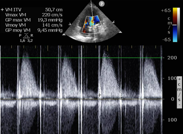 obstruction-rapide-un-lent-d&eacute;blocage-figure1