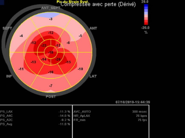 amylose-et-arythmie-figure1