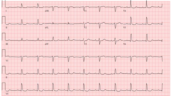 Ancien ECG