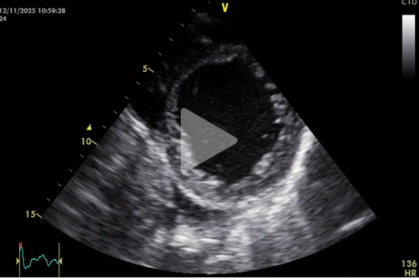 Complication-rare-d-un-remplacement-valvulaire-mitrale-video2-img.jpg