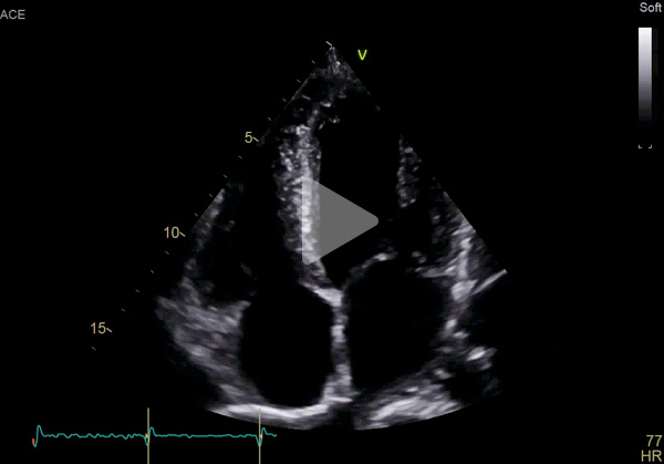 Vidéo 3 - cas clinique "Une amylose AL précoce"