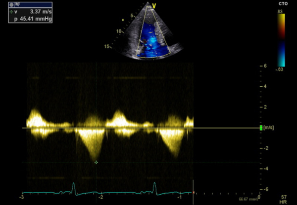 Figure 1 : Gradient d’obstruction intra-VG provoqué à l’effort