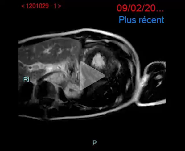 Syndrome_oedémateux_video6_img
