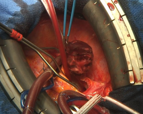 Ball thrombus