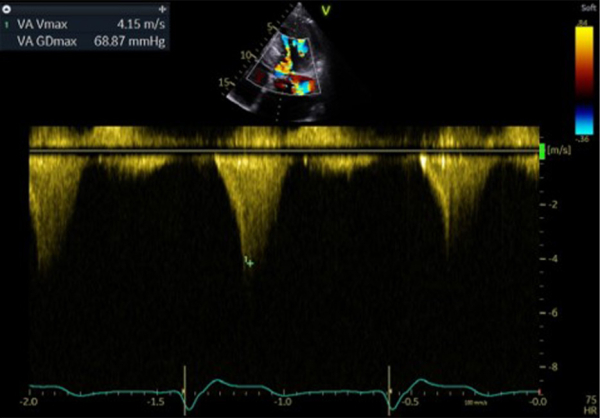 Flux Doppler continu trans-aortique