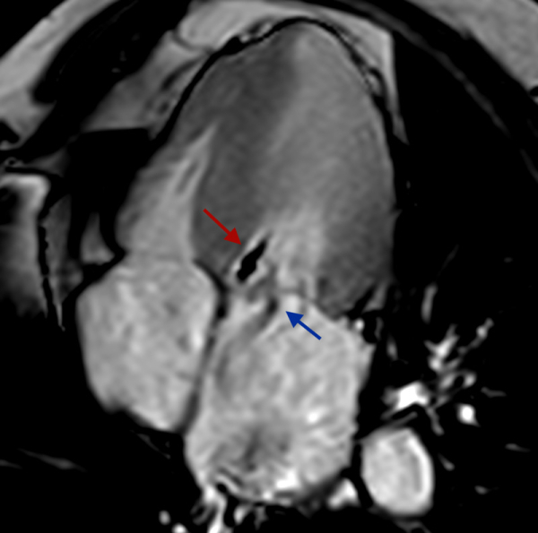 Figure 2 : Ciné-IRM montrant un flux d’obstruction sous-aortique (flèche rouge) en regard d’une zone d’hypertrophie septale associée à une régurgitation mitrale (flèche bleue)