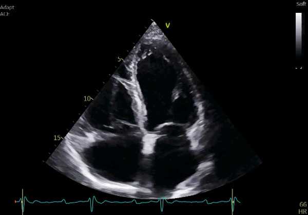 Figure 2 : Échocardiographie transthoracique