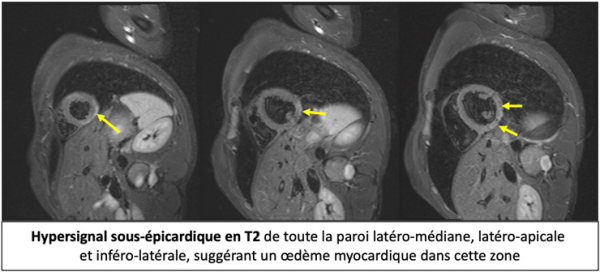 imagerie-cardiaque-cas-clinique-en-direct-de-Lariboisiere-sequence-sequence-t2-stir