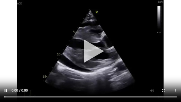 Vidéo 1. Coupe parasternale grand axe