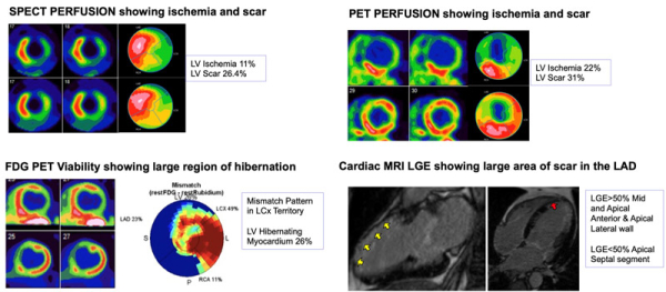 Figure 1. Étude de l’ischémie, de la viabilité et des séquelles myocardiques par les tests d’imagerie.