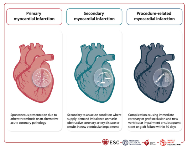 ESC 2026 - 5&egrave;me d&eacute;finition universelle de l'IDM : Figure 1 - Les trois nouvelles cat&eacute;gories d'infarctus du myocarde.