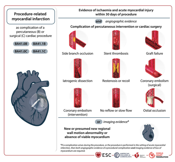 reco-infarctus-figure-4-infarctus-du-myocarde-lie-a-une-procedure.jpg