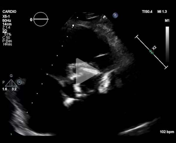 TAVI-dans-l-endocardite-aortique-destructrice-video2-img.jpg
