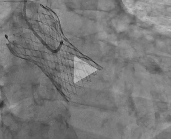 Deux-ans-apr&egrave;s-un-TAVI-le-silence-du-sinus-coronaire-gauche-video2-img.jpg