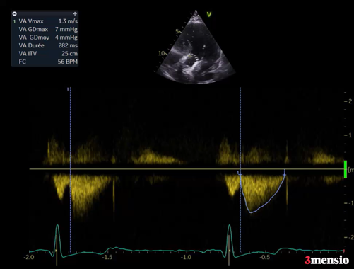 Gradient transvalvulaire: 4 mmHg - Pas de fuite p&eacute;ri-proth&eacute;tique