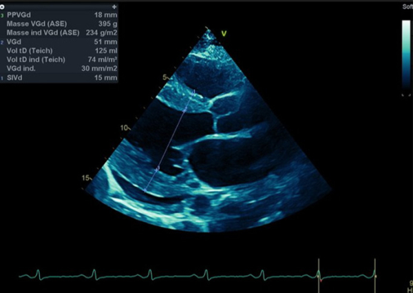 Examens du patient : Echocardiographie bilan de dyspnée , en RS