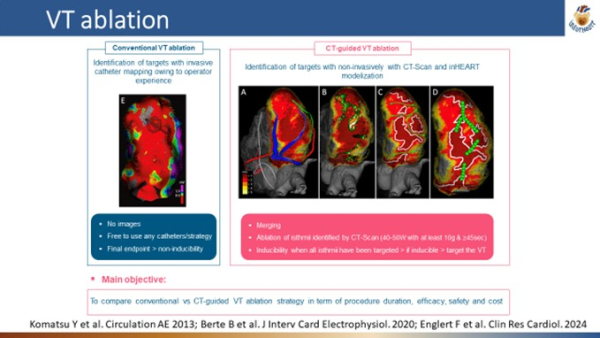 VT ablation