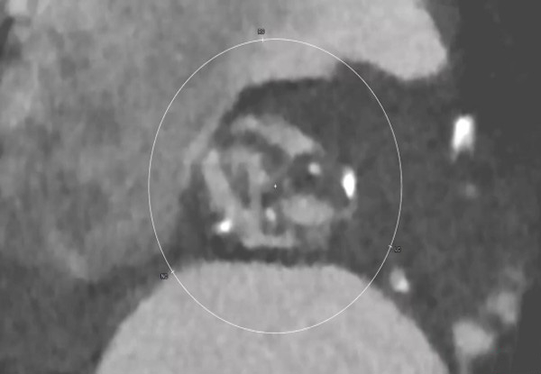 TAVI-dans-l-endocardite-aortique-destructrice-img1.jpg