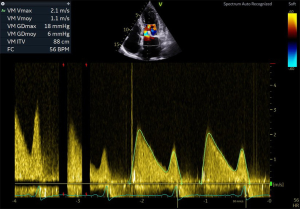 Gradient trans-mitral en doppler continu