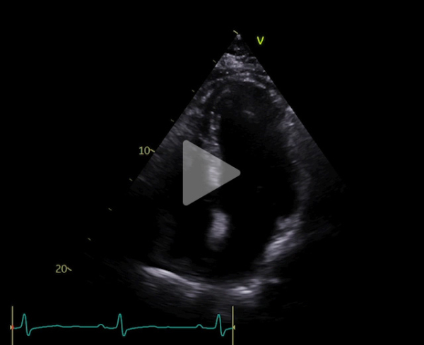 peu-d-hypertrophie-beaucoup-d-oedème-video1-img