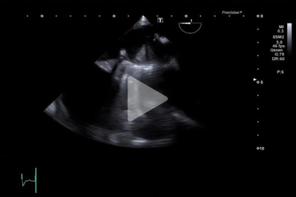 Complication-rare-d-un-remplacement-valvulaire-mitrale-video8-img.jpg
