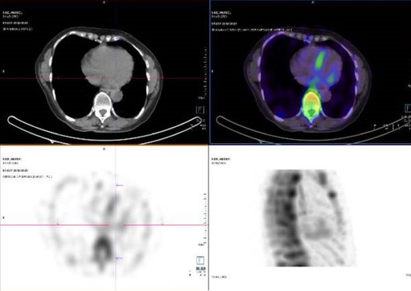 Figure 3 : Coupes tomographiques cardiaques couplées à la scintigraphie corps entiers au DPD, confirmant l’hyperfixation du myocarde (et non pas du pool sanguin intra-cardiaque comme parfois observé en cas de ralentissement du flux sanguin).