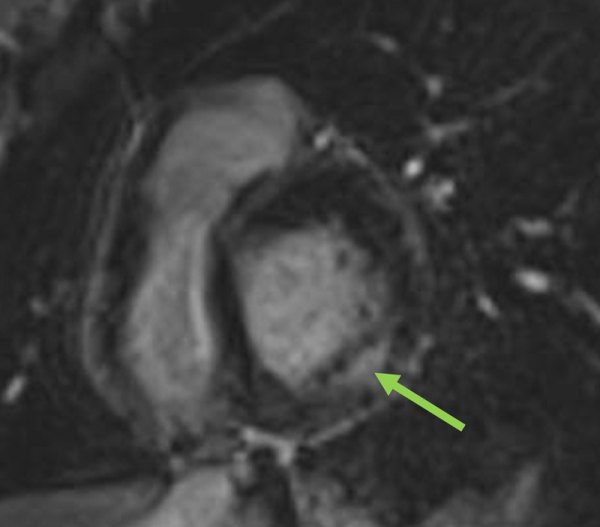Figure 3 : Présence de fibrose myocardique mésomyocardique inféro-latérale typiquement observée en IRM cardiaque (10 min après injection de Gadolinium) dans la maladie de Fabry, ici chez une femme Fabry avec HVG mesurée à seulement 11-12 mm.