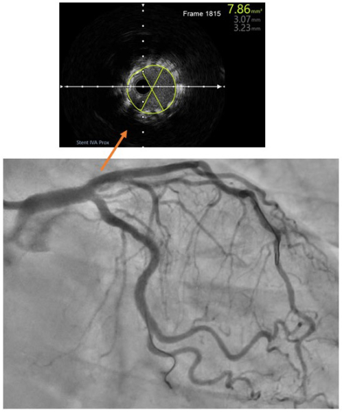 Extrait du run final d’IVUS post angioplastie