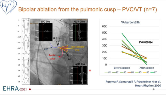 L’ablation bipolaire