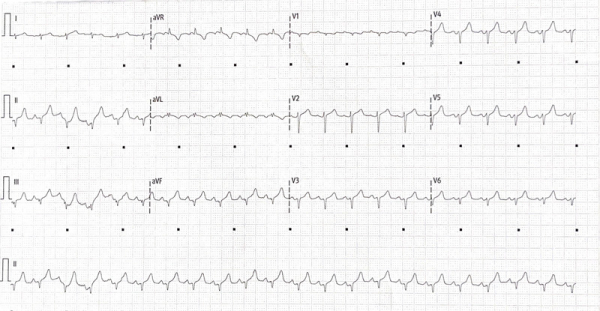 Figure 1. ECG phase initiale 