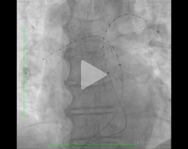 un-infarctus-mais-pas-du-myocarde-vidéo12-img