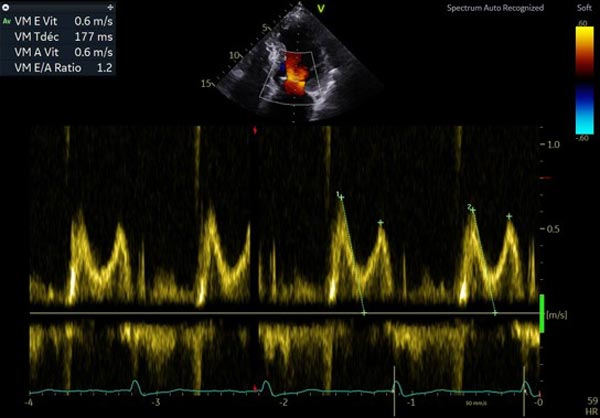 ETT de contrôle à 6 mois - Profil mitral normal
