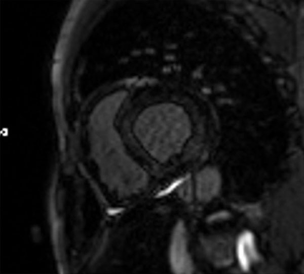 Image 5 du cas clinique "Une amylose AL précoce"